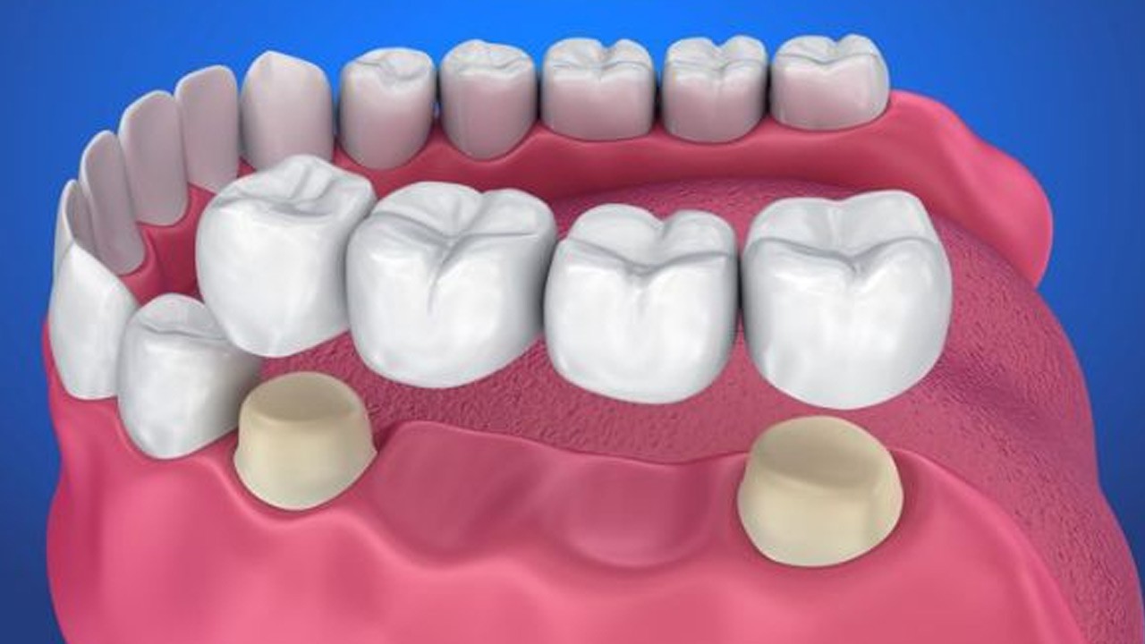 Kinh nghiệm giảm đau khi trồng răng giả